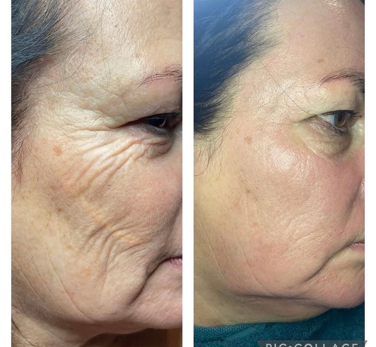 Intense green sea peeling, verbetert de huidstructuur. verminderd lijntjes, verminderd pigement vlekken, littekens en acne. 