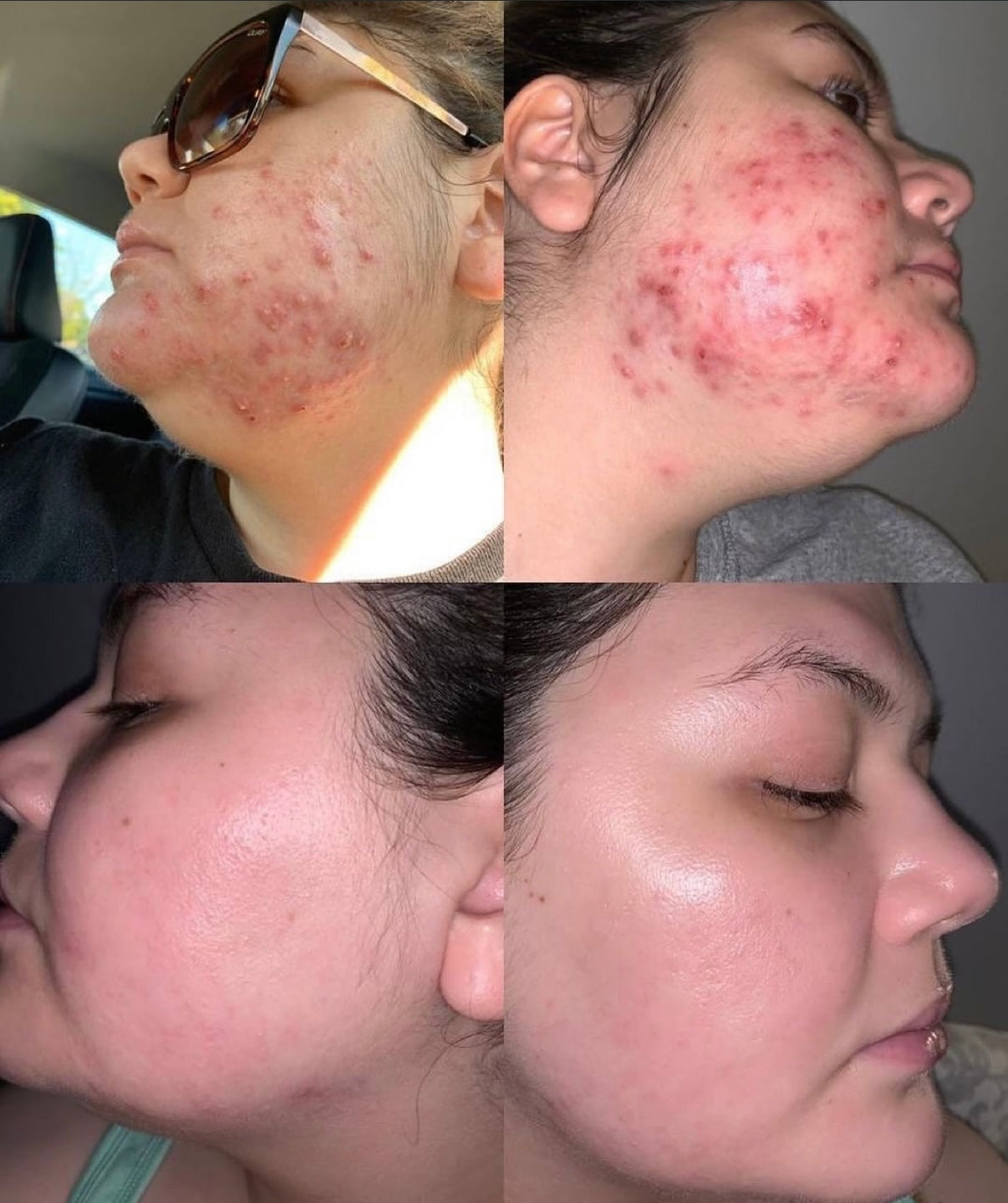 Green sea peeling voor littekens, acne, pigmentvlekken en fijne lijntjes 